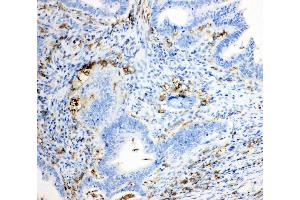 Anti-TRPC6 antibody, IHC(P) IHC(P): Human Intestinal Cancer Tissue (TRPC6 Antikörper  (Middle Region))