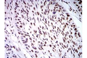 Immunohistochemical analysis of paraffin-embedded esophageal cancer tissues using ZFP91 mouse mAb with DAB staining. (ZFP91 Antikörper  (AA 162-304))