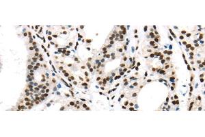 Immunohistochemistry of paraffin-embedded Human thyroid cancer using DDX39B Polyclonal Antibody at dilution of 1/40 (DDX39B Antikörper)