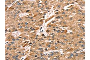 The image on the left is immunohistochemistry of paraffin-embedded Human liver cancer tissue using ABIN7192291(SDC3 Antibody) at dilution 1/30, on the right is treated with synthetic peptide. (SDC3 Antikörper)