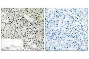 Immunohistochemistry analysis of paraffin-embedded human breast carcinoma tissue using TCEAL4 antibody. (TCEAL4 Antikörper)