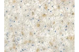 ABIN7094012 and ABIN7098056 at 1/100 staining human astrocytoma by IHC-P.