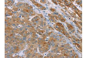 The image on the left is immunohistochemistry of paraffin-embedded Human liver cancer tissue using ABIN7192256(SAMD4A Antibody) at dilution 1/30, on the right is treated with synthetic peptide. (SAMD4A Antikörper)