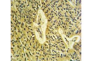 SMAD7 antibody IHC analysis in formalin fixed and paraffin embedded lung carcinoma.