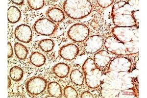Immunohistochemical analysis of paraffin-embedded Human Colon Carcinoma Tissue using Acetyl P53(K382) Mouse mAb diluted at 1:2000 (p53 Antikörper  (acLys382))