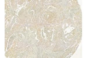 ABIN6259331 and ABIN6275349 at 1/100 staining human lung squamous cell carcinoma by IHC-P. (PEX14 Antikörper  (Internal Region))