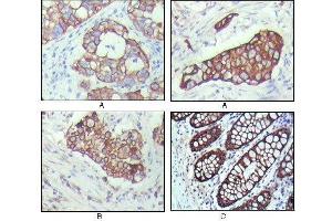 Immunohistochemical analysis of paraffin-embedded human breast carcinoma(A), lung cancer(B) and normal colon tissue(C), showing cytoplasmic localization with DAB staining using KRT19 mouse mAb. (Cytokeratin 19 Antikörper  (AA 80-400))