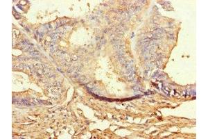 Immunohistochemistry of paraffin-embedded human endometrial cancer using ABIN7160080 at dilution of 1:100 (BUB1B Antikörper  (AA 230-394))