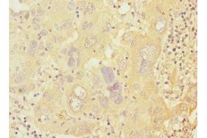 Immunohistochemistry of paraffin-embedded human liver cancer using ABIN7146619 at dilution of 1:100 (PRKAR1B Antikörper  (Regulatory Subunit))