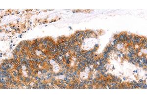 Immunohistochemistry of paraffin-embedded Human colon cancer tissue using AFDN Polyclonal Antibody at dilution 1:40 (Afadin Antikörper)