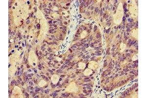 Immunohistochemistry of paraffin-embedded human colon cancer using ABIN7146326 at dilution of 1:100