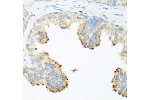 Immunohistochemistry of paraffin-embedded human prostate using PLEK antibody (ABIN6290796) at dilution of 1:200 (40x lens). (Pleckstrin Antikörper)