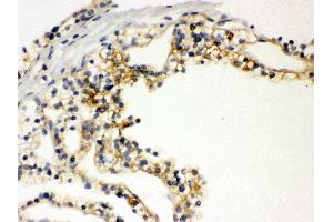 Anti- SLC12A1 Picoband antibody, IHC(P) IHC(P): Human Kidney Cancer Tissue (SLC12A1 Antikörper  (N-Term))