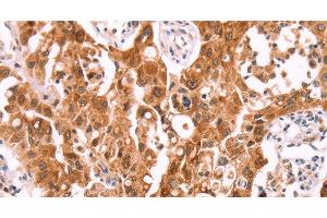 Immunohistochemistry of paraffin-embedded Human lung cancer using NCEH1 Polyclonal Antibody at dilution of 1:80 (NCEH1 Antikörper)
