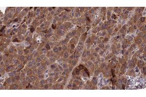 ABIN6277268 at 1/100 staining Human liver cancer tissue by IHC-P. (PAK1 Antikörper  (N-Term))