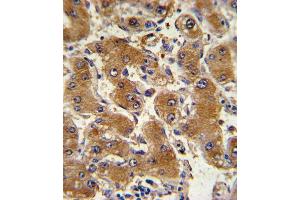 Formalin-fixed and paraffin-embedded human hepatocarcinoma with COL6A1 Antibody (C-term), which was peroxidase-conjugated to the secondary antibody, followed by DAB staining. (COL6A1 Antikörper  (C-Term))