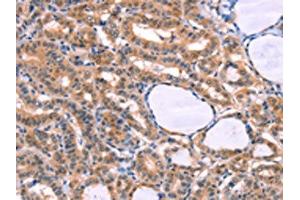 The image on the left is immunohistochemistry of paraffin-embedded Human thyroid cancer tissue using ABIN7129127(CYP1B1 Antibody) at dilution 1/20, on the right is treated with fusion protein. (CYP1B1 Antikörper)