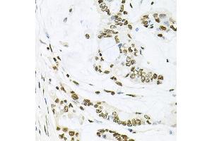 Immunohistochemistry of paraffin-embedded human gastric cancer using MAPK8 antibody (ABIN5970116) at dilution of 1/100 (40x lens). (JNK Antikörper)