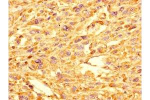 Immunohistochemistry of paraffin-embedded human melanoma using ABIN7154300 at dilution of 1:100 (GOLPH3L Antikörper  (AA 6-285))