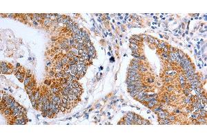 Immunohistochemistry of paraffin-embedded Human colon cancer tissue using Claudin 10 Polyclonal Antibody at dilution 1:50 (CLDN10 Antikörper)