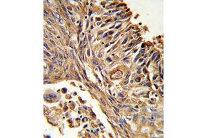 Formalin-fixed and paraffin-embedded human lung carcinoma reacted with IL18RAP Antibody (N-term), which was peroxidase-conjugated to the secondary antibody, followed by DAB staining. (IL18RAP Antikörper  (N-Term))