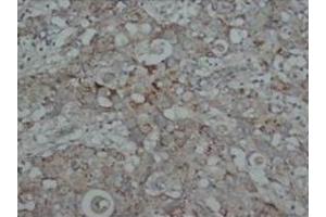 Immunohistochemical analysis of parafin-embedded human intestine cancer tissue sections using SMAD2/3 antibody (SMAD2 Antikörper  (N-Term))