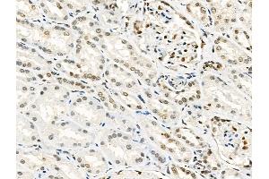 Phospho-Progesterone Receptor (Ser190) Antibody at 1/100 staining Human kidney cancer by IHC-P.
