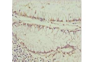 Immunohistochemistry of paraffin-embedded human colon cancer using ABIN7163634 at dilution of 1:100 (PDGFRL Antikörper  (AA 15-205))