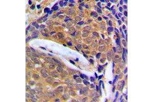 Immunohistochemical analysis of Cystatin B staining in human breast cancer formalin fixed paraffin embedded tissue section. (CSTB Antikörper  (Center))