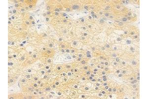 ABIN6264089 and ABIN6279283 at 1/100 staining human hepatocellular carcinoma by IHC-P. (PDE2A Antikörper  (C-Term))
