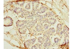 Immunohistochemistry of paraffin-embedded human breast cancer using ABIN7162370 at dilution of 1:100 (OSGIN2 Antikörper  (AA 1-250))