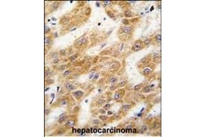 Formalin-fixed and paraffin-embedded human hepatocarcinoma tissue reacted with ALDH4A1 antibody (C-term), which was peroxidase-conjugated to the secondary antibody, followed by DAB staining. (ALDH4A1 Antikörper  (C-Term))