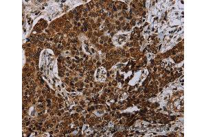 Immunohistochemistry of Human liver cancer using NDUFA4 Polyclonal Antibody at dilution of 1:40 (NDUFA4 Antikörper)