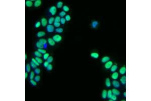 Immunofluorescent staining of human breast adenocarcinoma. (GATA3 Antikörper)