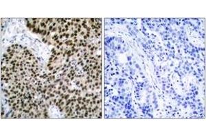 Immunohistochemistry analysis of paraffin-embedded human breast carcinoma tissue, using HSF1 (Ab-303) Antibody. (HSF1 Antikörper  (AA 270-319))