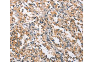 Immunohistochemistry of Human thyroid cancer using CHMP1A Polyclonal Antibody at dilution of 1:60