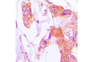 Immunohistochemical analysis of Involucrin staining in human lung cancer formalin fixed paraffin embedded tissue section. (Involucrin Antikörper  (C-Term))