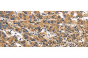 Immunohistochemistry of paraffin-embedded Human liver cancer tissue using UBTD2 Polyclonal Antibody at dilution 1:35 (UBTD2 Antikörper)