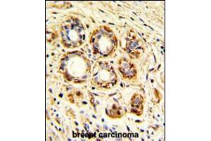 Formalin-fixed and paraffin-embedded human breast carcinoma with, which was peroxidase-conjugated to the secondary antibody, followed by DAB staining. (Cathepsin K Antikörper  (AA 207-237))