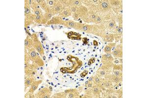 Immunohistochemistry of paraffin-embedded human liver injury using RAB27A antibody at dilution of 1:200 (400x lens). (RAB27A Antikörper)
