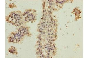 Immunohistochemistry of paraffin-embedded human breast cancer using ABIN7174707 at dilution of 1:100 (RPAP2 Antikörper  (AA 1-154))