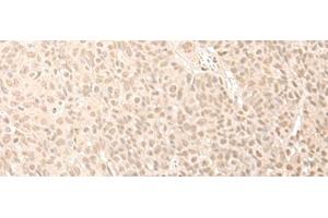 Immunohistochemistry of paraffin-embedded Human esophagus cancer tissue using CNOT10 Polyclonal Antibody at dilution of 1:50(x200) (CNOT10 Antikörper)