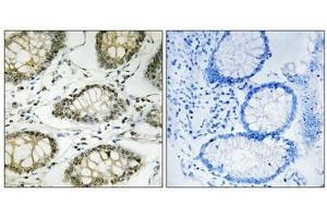 Immunohistochemistry analysis of paraffin-embedded human colon carcinoma tissue using ATR (Phospho-Ser428) antibody. (ATR Antikörper  (pSer428))