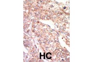 Formalin-fixed and paraffin-embedded human hepatocellular carcinoma tissue reacted with EPHA1 polyclonal antibody  , which was peroxidase-conjugated to the secondary antibody, followed by AEC staining. (EPHA1 Antikörper  (N-Term))