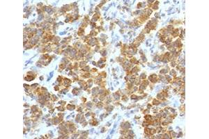 IHC testing of FFPE human parathyroid tumor with TL1A antibody (clone TLRM1-1). (TNFSF15 Antikörper)