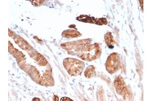 Formalin-fixed, paraffin-embedded human Breast Carcinoma stained with Flt3 / CD135 Mouse Monoclonal Antibody (FLT3/2458). (FLT3 Antikörper)