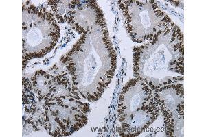 Immunohistochemistry of Human colon cancer using ELN Polyclonal Antibody at dilution of 1:50