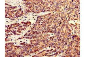Immunohistochemistry of paraffin-embedded human ovarian cancer using ABIN7148931 at dilution of 1:100 (CDK5 Antikörper  (AA 1-292))