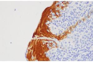 Immunohistochemistry of paraffin-embedded Human tonsil using S100A7 Polycloanl Antibody at dilution of 1:200 (S100A7 Antikörper)