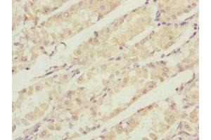 Immunohistochemistry of paraffin-embedded human gastric cancer using ABIN7146746 at dilution of 1:100 (CBR4 Antikörper  (AA 1-237))